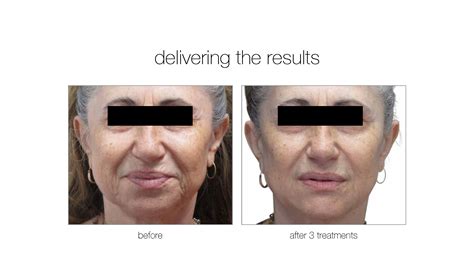 Miami Venus Viva Treatments .